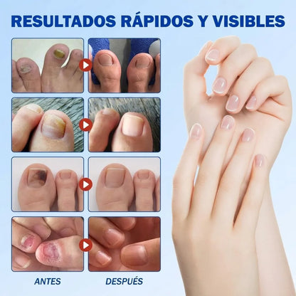 FungiFix™ Parches para Uñas Elimina Hongos 21 Parches